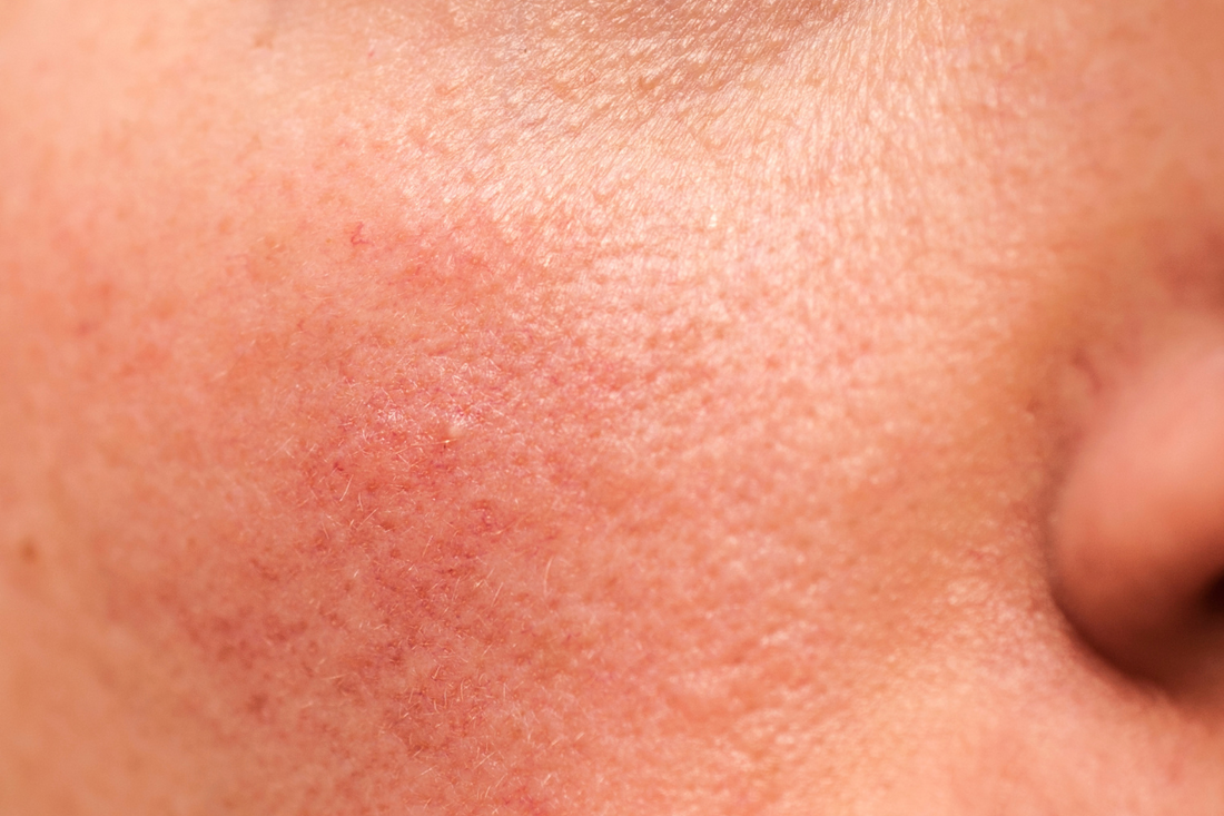 Was du über Rosacea wissen solltest